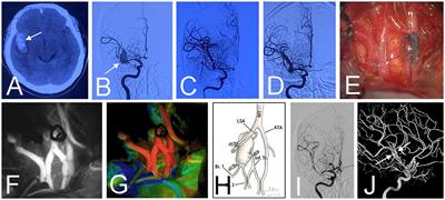 The surgical strategy and technical nuances of in situ side-to-side bypass for the management of complex intracranial aneurysms